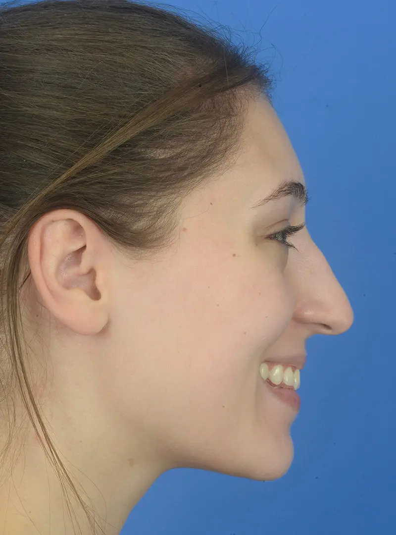 Rhinoplasty  79942 Profile Smiling Pre