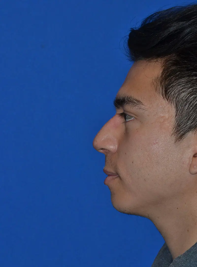 Primary Rhinoplasty profile 80124 Pre