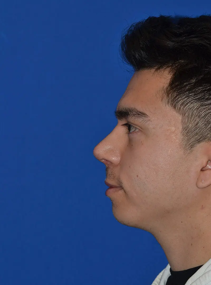 Primary Rhinoplasty profile 80124 Post