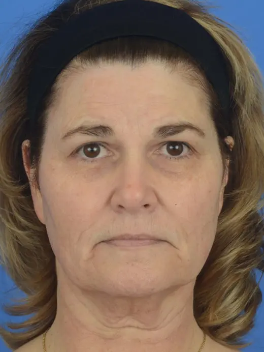 Submental Liposuction Facelift Rhytidectomy MVP Lift Facial Rejuvenation. 81630 Front view pre op