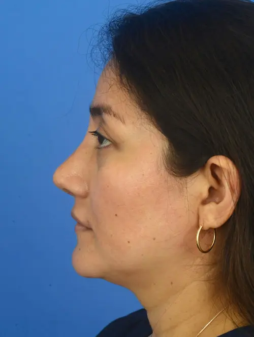 Revision rhinoplasty 83774 Profile View After