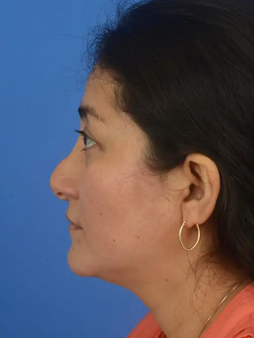 Revision rhinoplasty 83774 Profile View Before