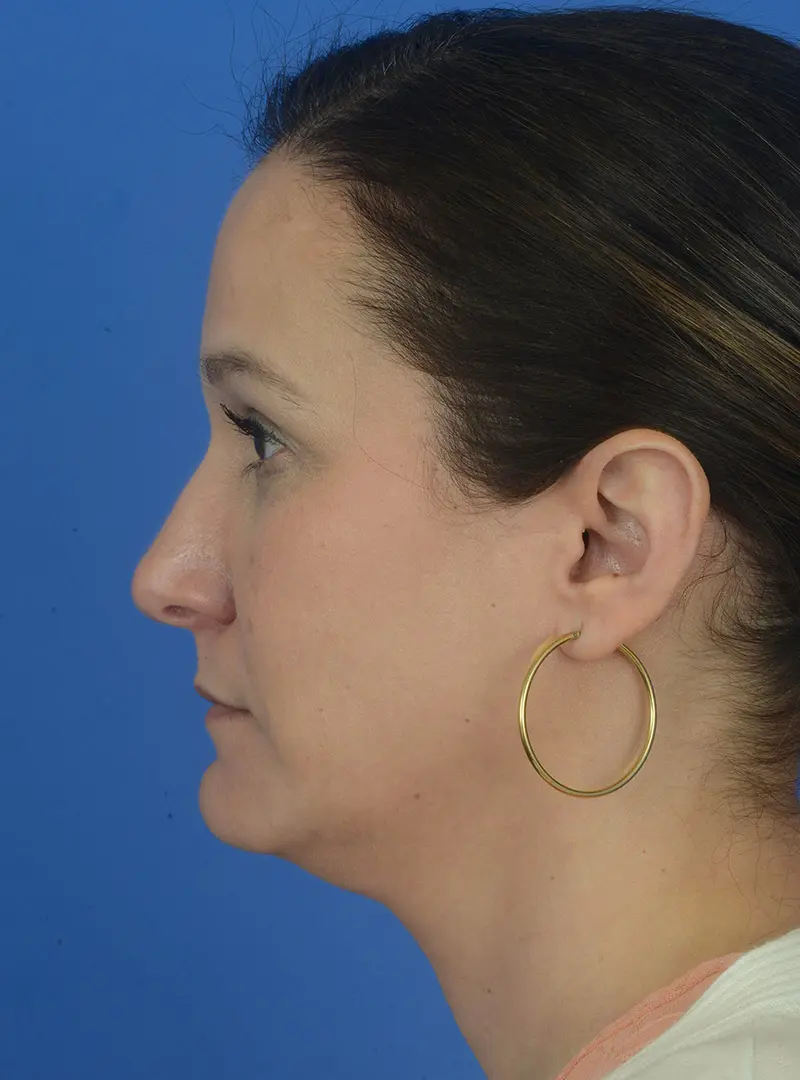 Rhinoplasty 83854 Pre Side