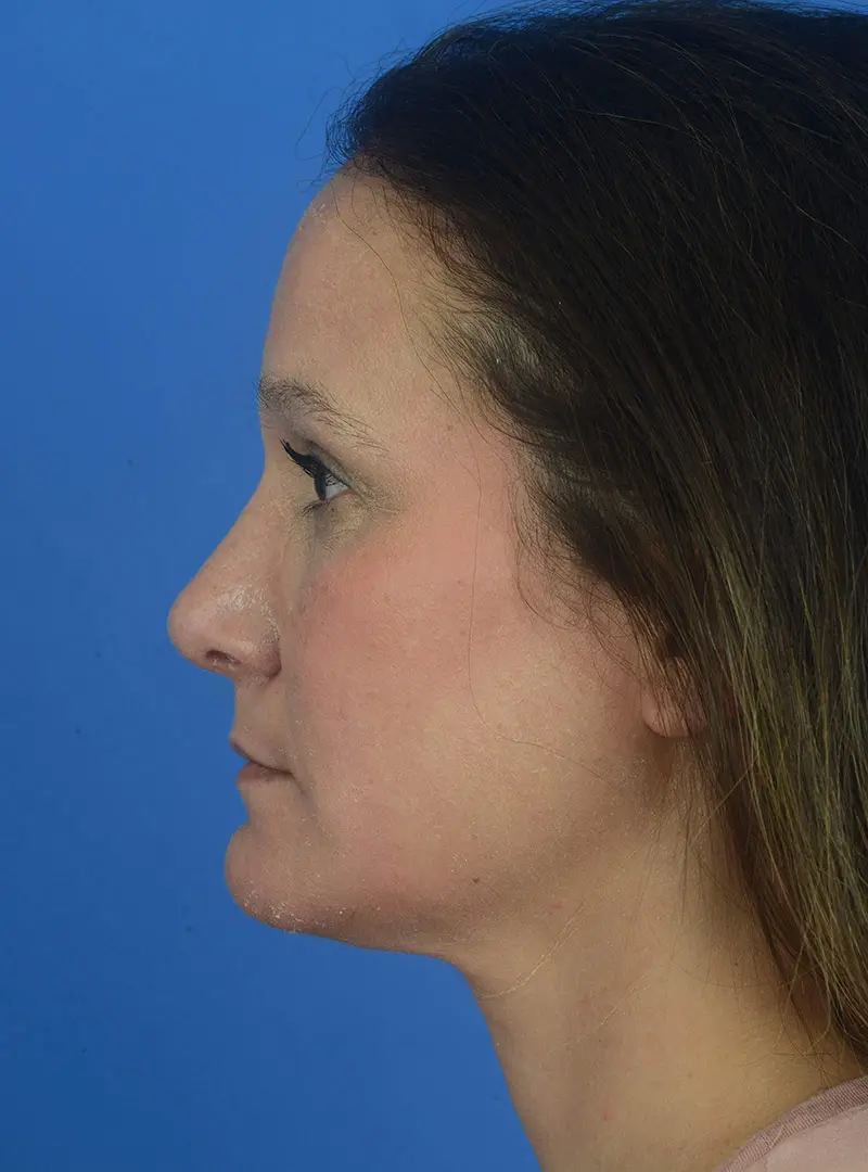 Rhinoplasty 83854 Post Side