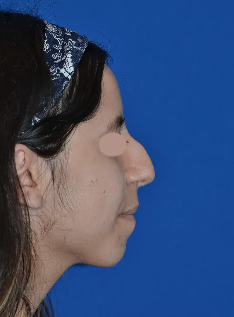 Primary-Rhinoplasty--amp--Septoplasty-for-severely-crooked-nose-in-Houston--TX | Before FaceTite™
