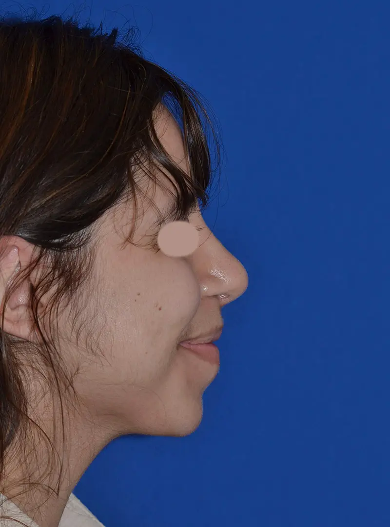 Primary-Rhinoplasty--amp--Septoplasty-for-severely-crooked-nose-in-Houston--TX | After FaceTite™