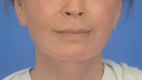 84725 Facelift Laser Skin Resurfacing Facial Wrinkles Rhytidectomy. Front view post op
