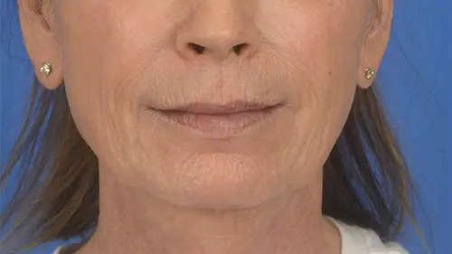 84725 Facelift Laser Skin Resurfacing Facial Wrinkles Rhytidectomy. Front view pre op