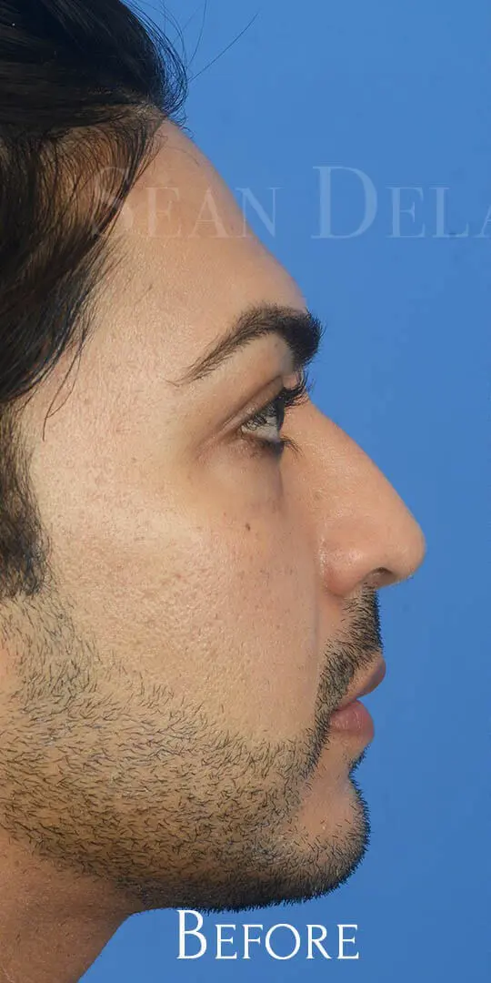Ethnic Rhinoplasty 85184 Profile Pre