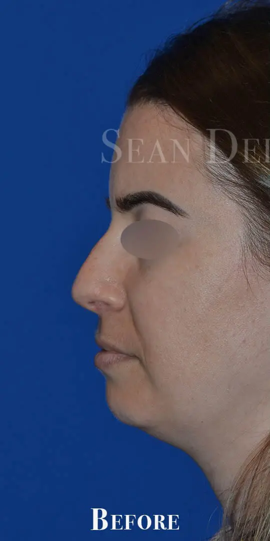Rhinoplasty-and-septoplasty-to-improve-breathing-and-nasal-appearance-in-Houston | Before Rhinoplasty