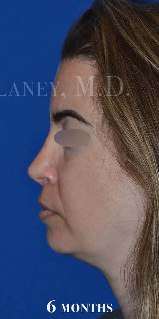 Rhinoplasty-and-septoplasty-to-improve-breathing-and-nasal-appearance-in-Houston | After Rhinoplasty
