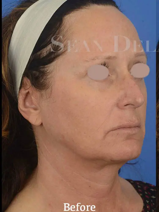 85187 facelift, brow lift, and CO2 laser skin resurfacing. Oblique view pre op
