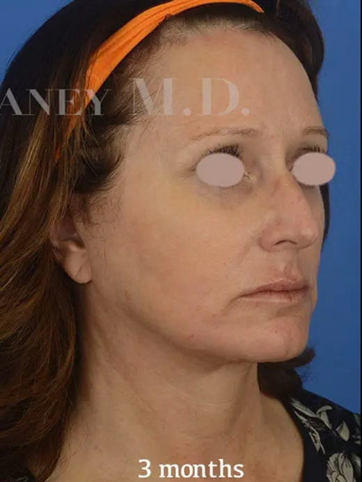 85187 facelift, brow lift, and CO2 laser skin resurfacing. Oblique view post op