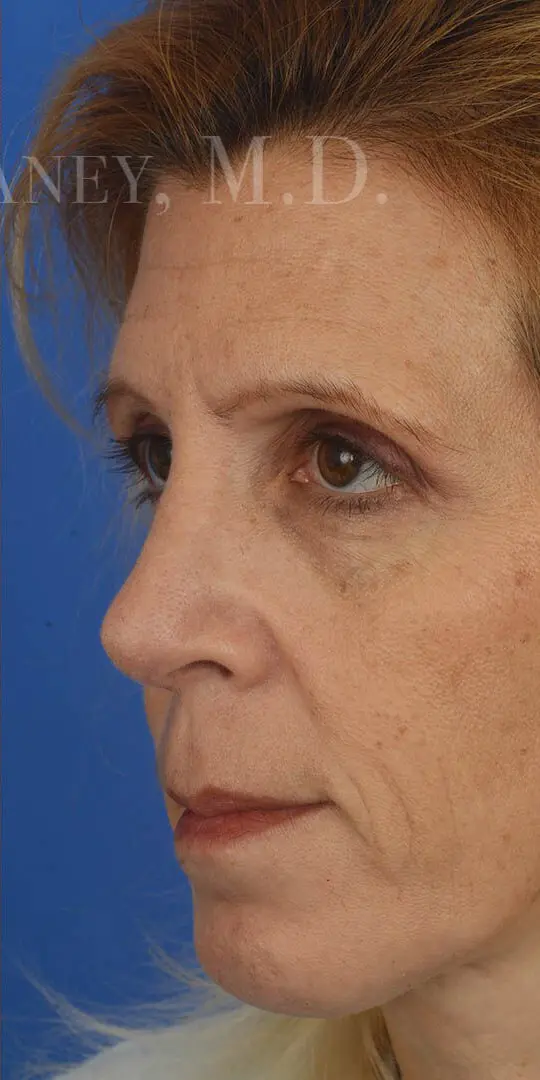 Rhinoplasty and Chin Augmentation - 85194 Oblique Post