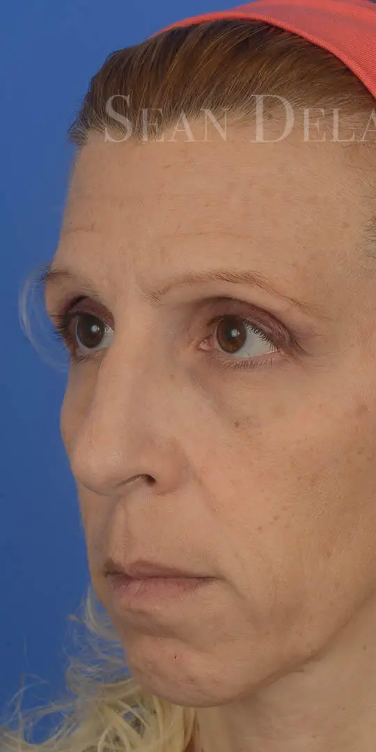 Rhinoplasty and Chin Augmentation - 85194 Oblique Pre