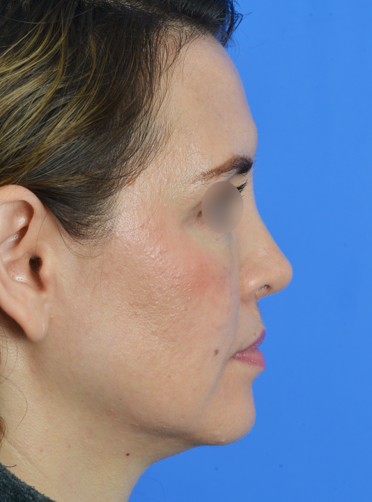 Case--7699 | After Central Neck Lift