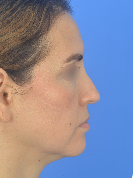 Case--7699 | Before Central Neck Lift