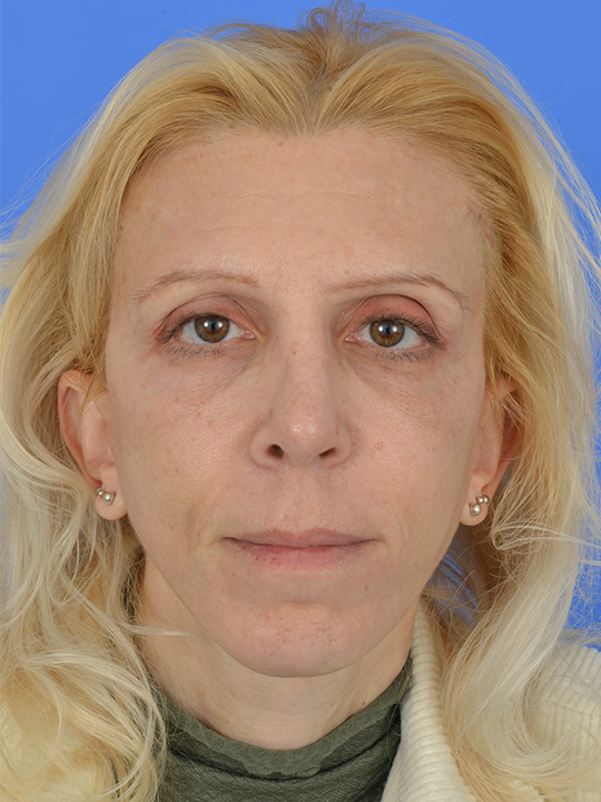 Case--4412 | After Rhinoplasty