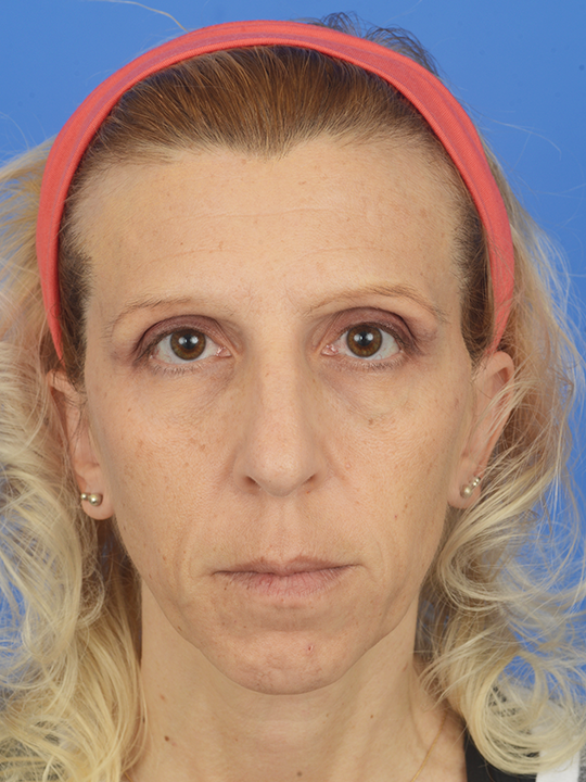 Case--4412 | Before Rhinoplasty