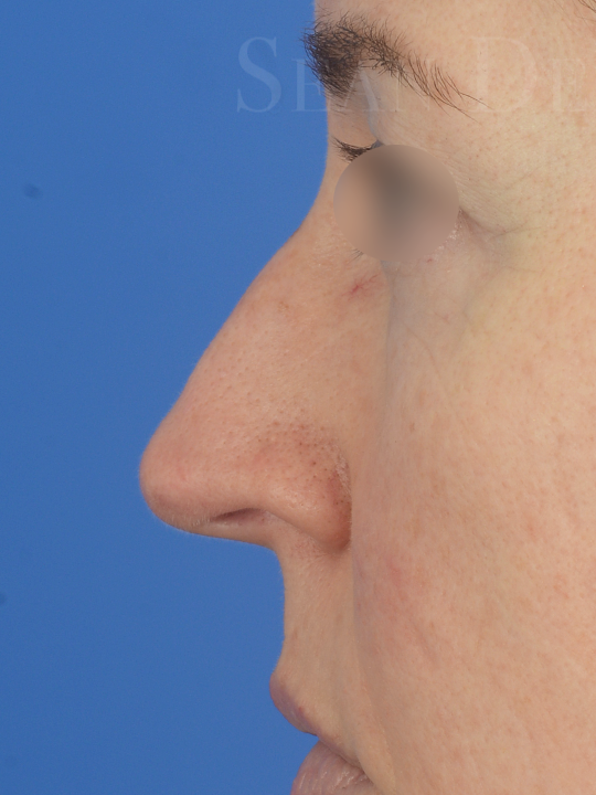 Case--8703 | Before FaceTite™