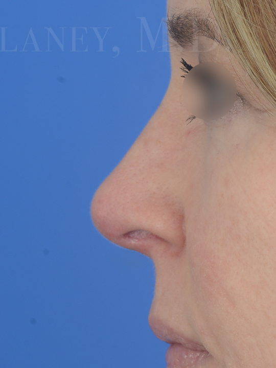 Case--8703 | After FaceTite™