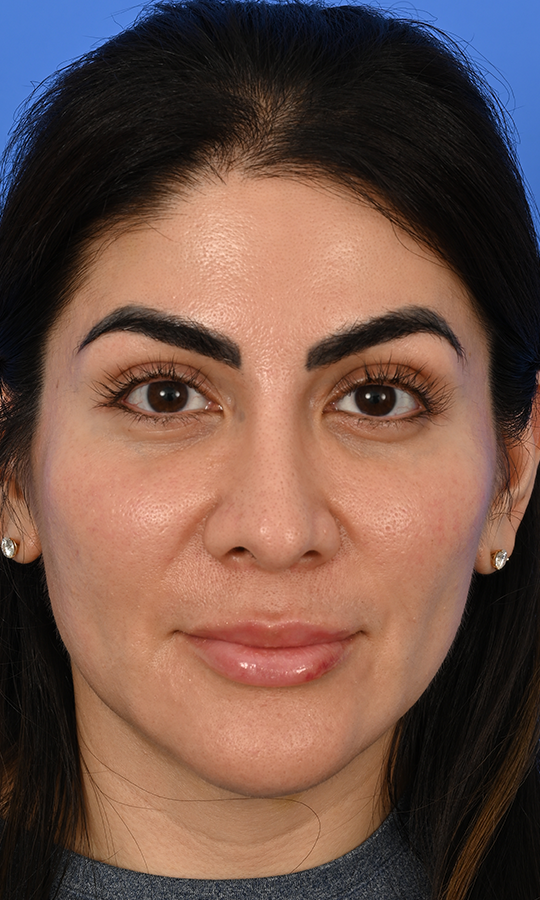 Case--5776 | After Rhinoplasty