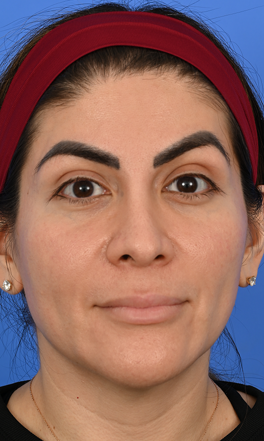 Case--5776 | Before Rhinoplasty