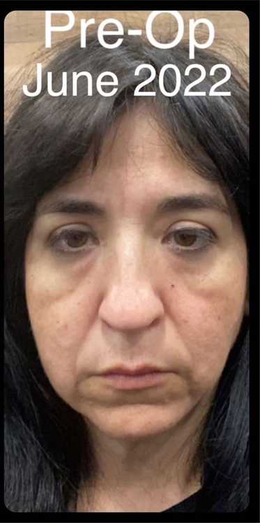Case--3433 | Before Ethnic Rhinoplasty