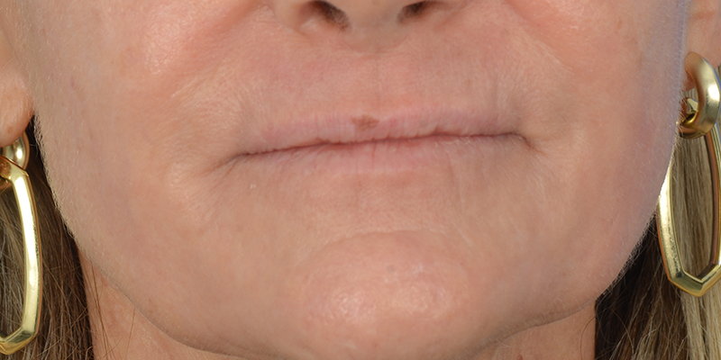 Case--2190 | After Revision Rhinoplasty