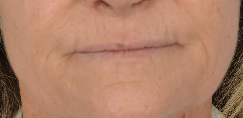 Case--2190 | Before Revision Rhinoplasty
