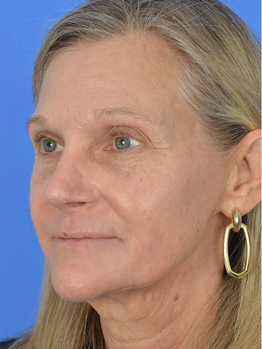 Case--3985 | After Facial Fat Transfer