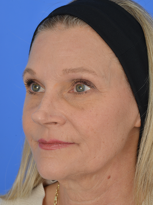 Case--3985 | Before Facial Fat Transfer