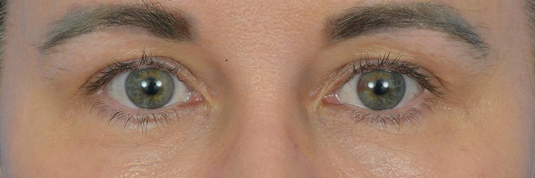 Case--3558 | Before FaceTite™