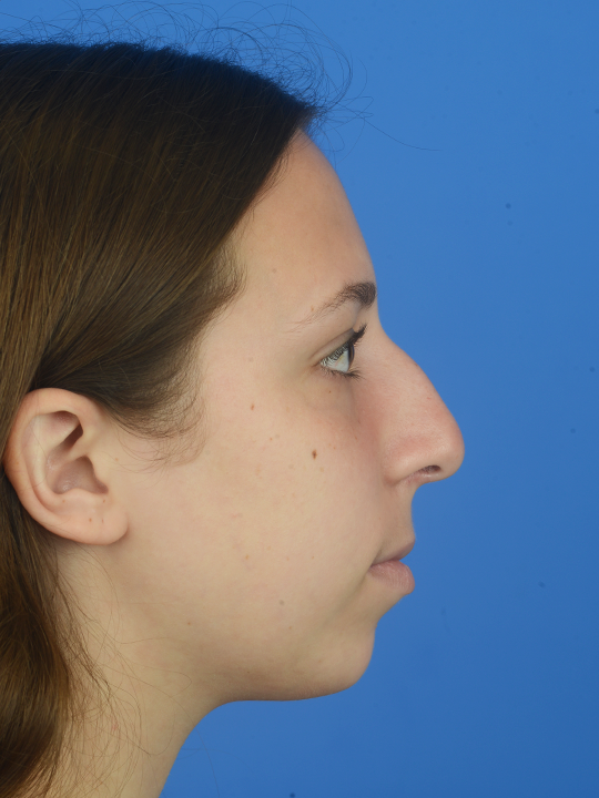 Teenage-Rhinoplasty-to-reduce-hump-and-elevate-tip-in-Houston--TX | Before Buccal Fat Removal