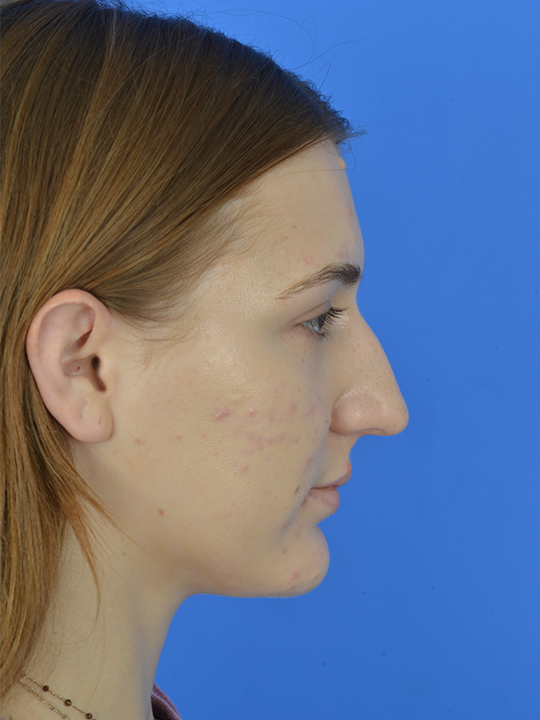 Case--7993 | Before Revision Rhinoplasty