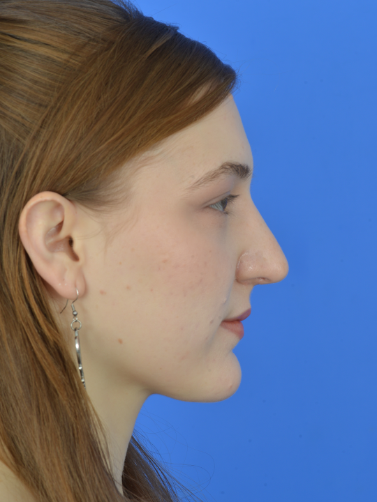 Case--7993 | After Revision Rhinoplasty