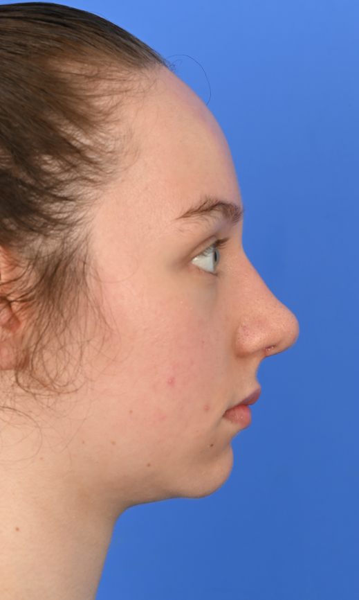Case--3973 | After Buccal Fat Removal