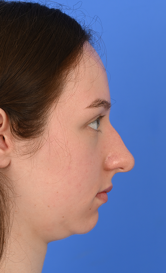 Case--3973 | Before Buccal Fat Removal