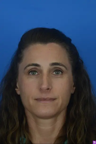 Revision Rhinoplasty Pre-operative photo front view