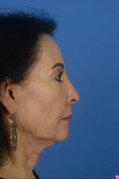 Case--7563 | Before Ethnic Rhinoplasty