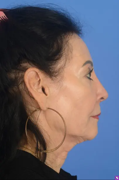 Case--7563 | After Ethnic Rhinoplasty