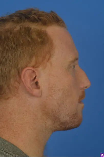 Case--2470 | Before Rhinoplasty