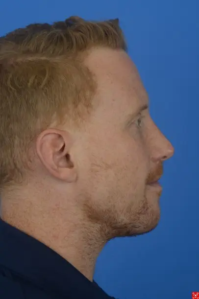 Case--2470 | After Rhinoplasty