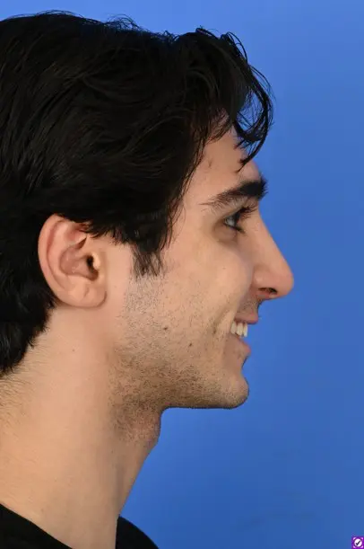 Case--8214 | After Ethnic Rhinoplasty