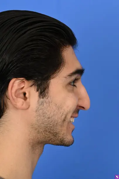 Case--8214 | Before Ethnic Rhinoplasty