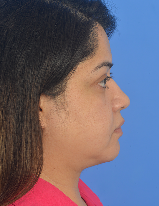 Case--4035 | Before Eyelid Surgery