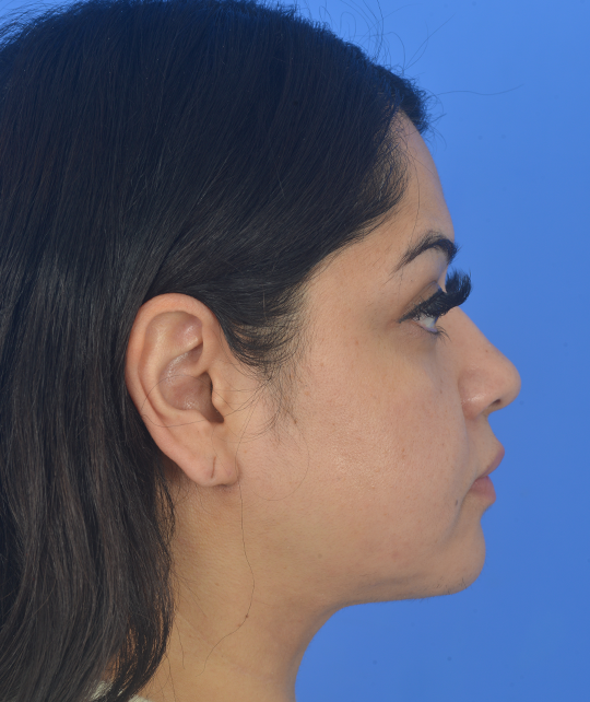 Case--4035 | After Eyelid Surgery