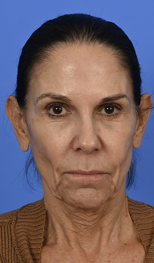 Case--9753 | Before Buccal Fat Removal
