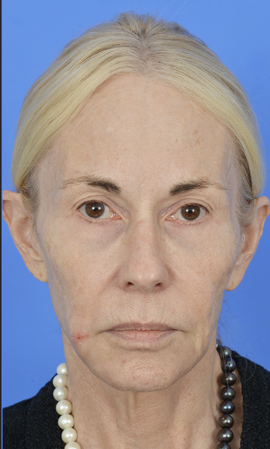 Case--2619 | Before Brow Lift