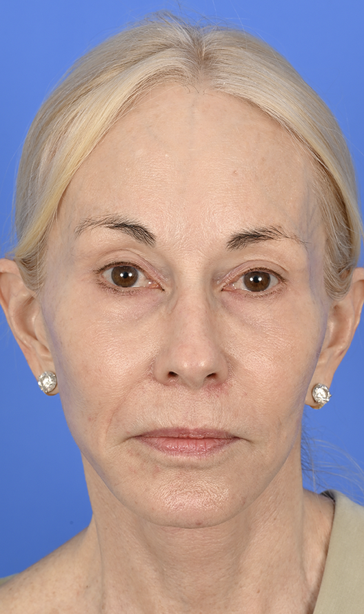 Case--2619 | After Brow Lift